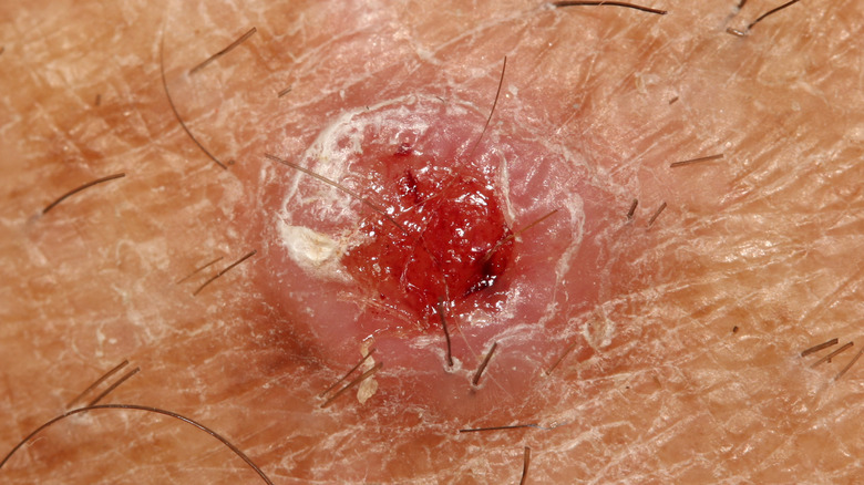 squamous cell carcinoma 