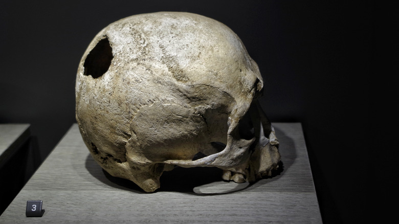 skull hole trepanation