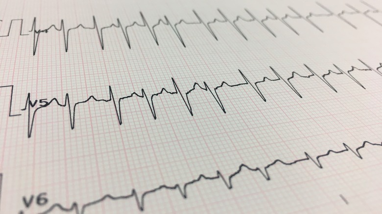 closeup of EKG reading of heart rate