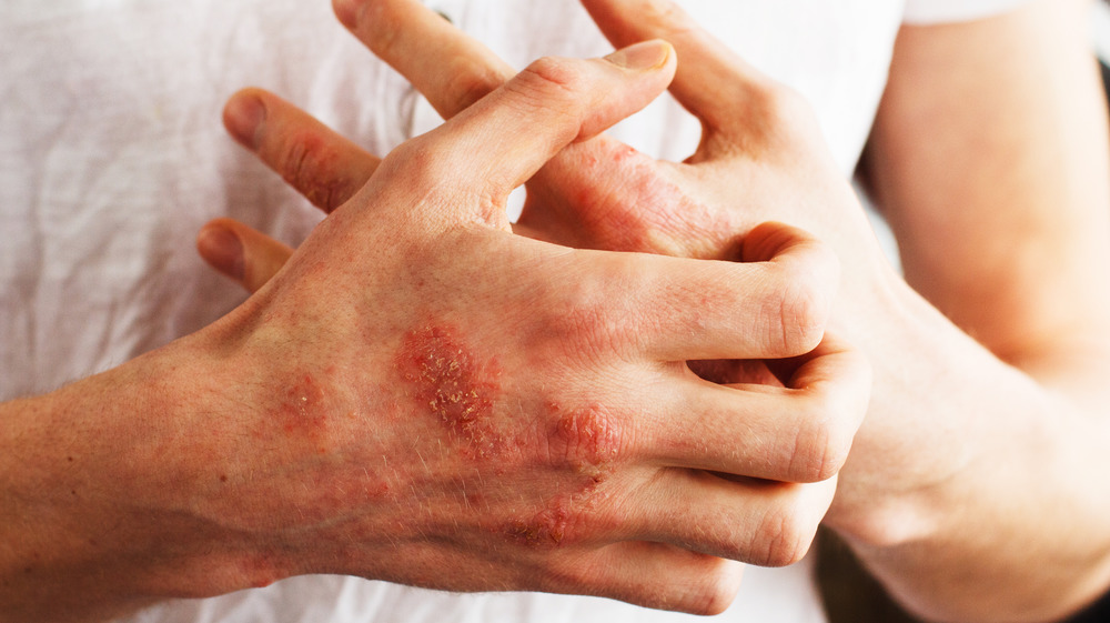 man scratching hives on hand