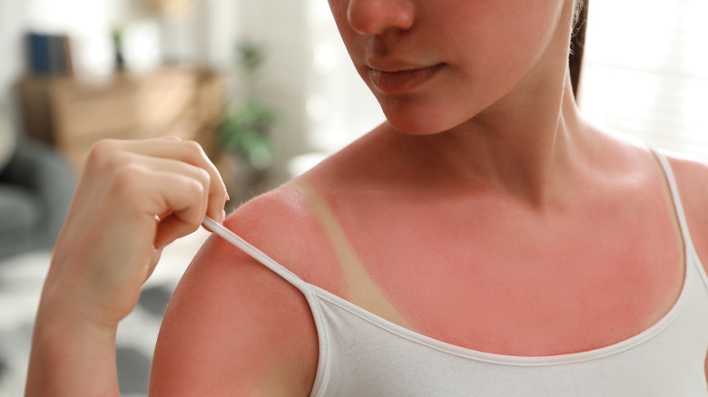 woman with bad sunburn