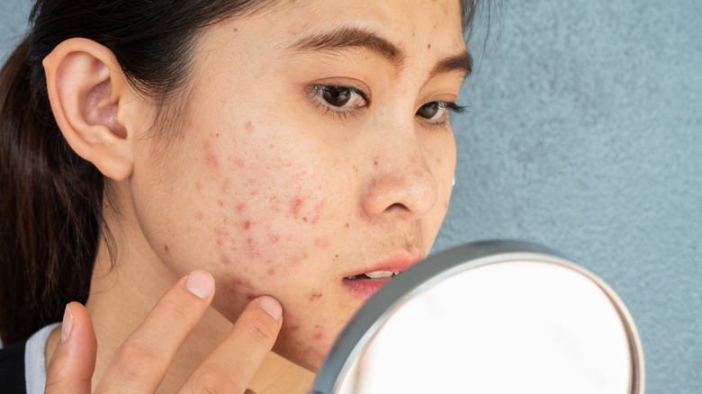 young woman examining her acne 