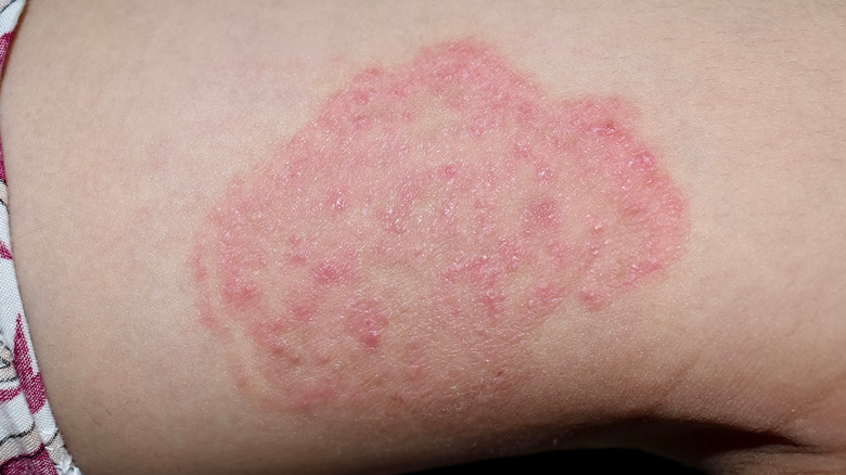 Visible infection on inner thigh