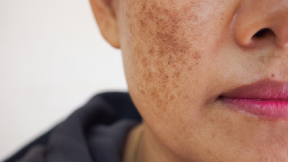 Melasma on cheeks