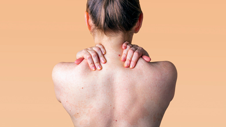 woman back fungal acne