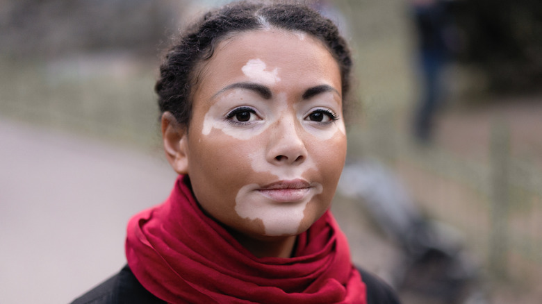 Woman with dark eyes and vitiligo