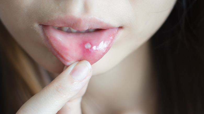 woman exposing a canker sore on her lip 