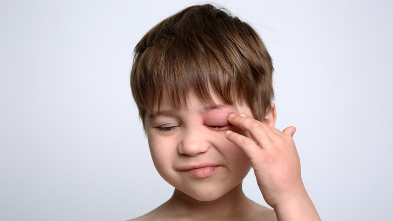 child rubbing very swollen eye