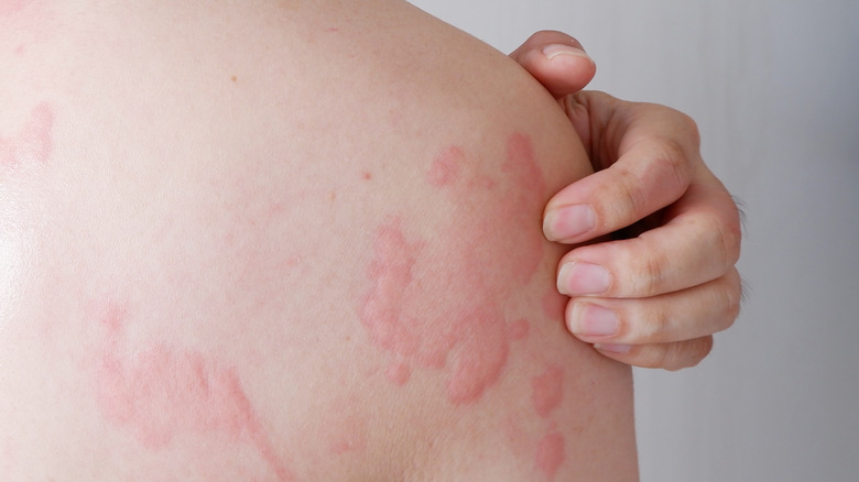 welts on skin of a woman's shoulder