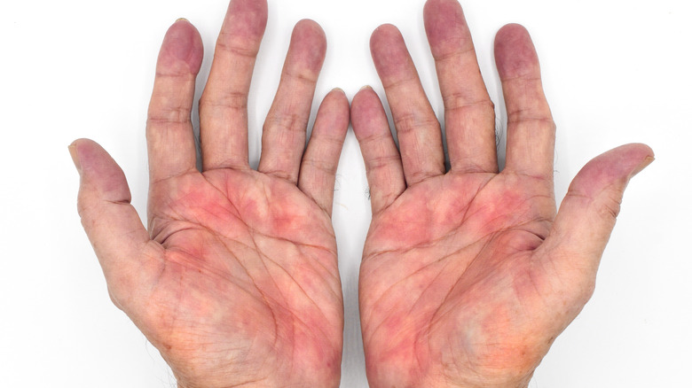 hands with palmar erythema