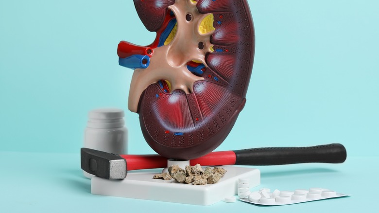 Model of kidney with stones