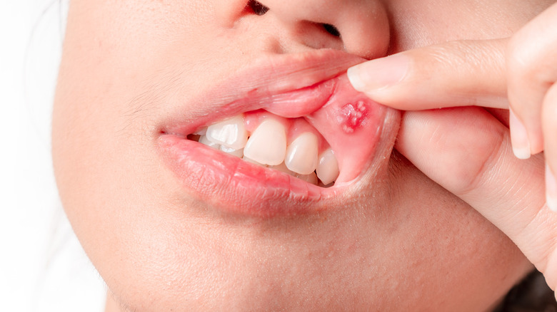 Woman showing mouth sore