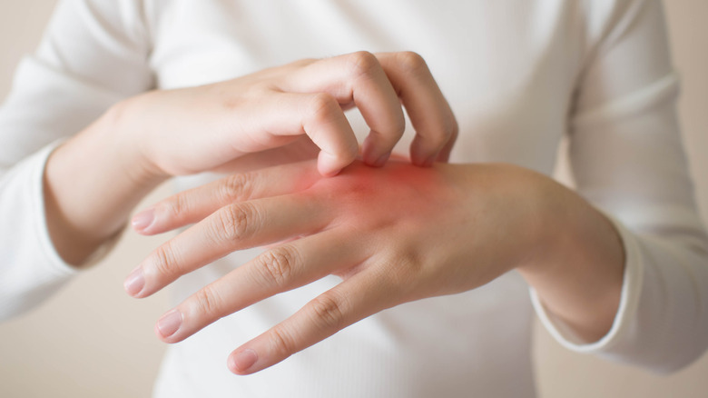 Close up of a person in a white shirt scratching a red spot on their hand