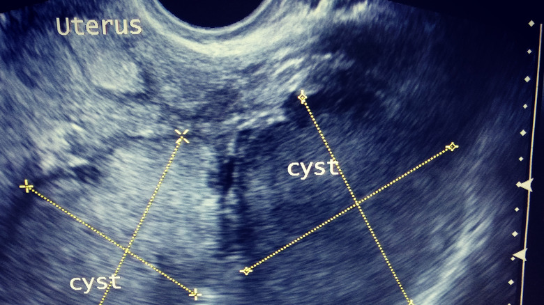 Ultrasound image of ovarian cysts