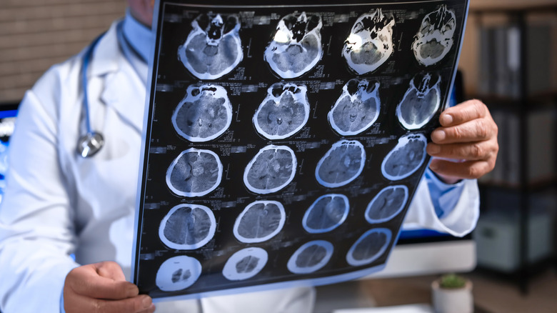 Physician looking at brain radiographs