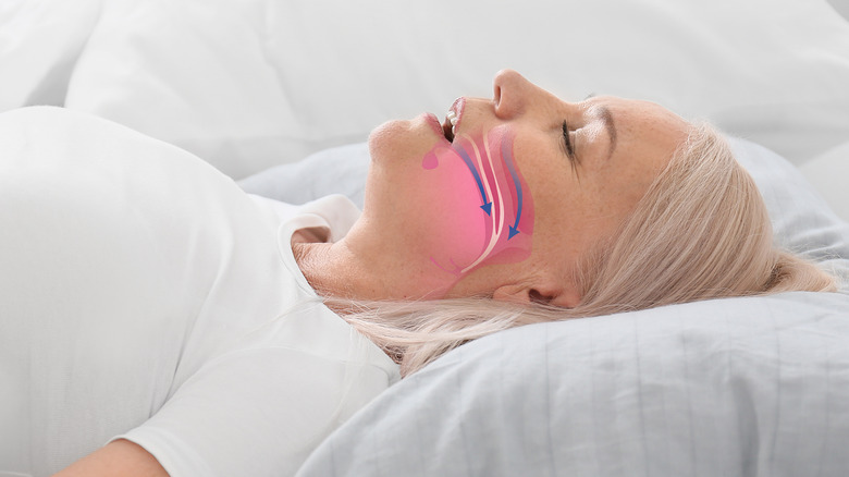 Sleeping woman with illustration of obstructive sleep apnea