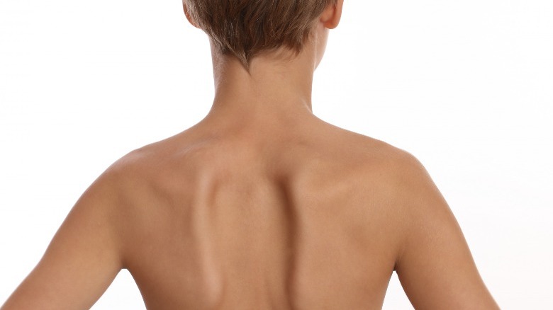 uneven shoulder blades from scoliosis