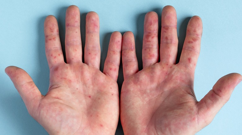 Rashes on palms on blue background