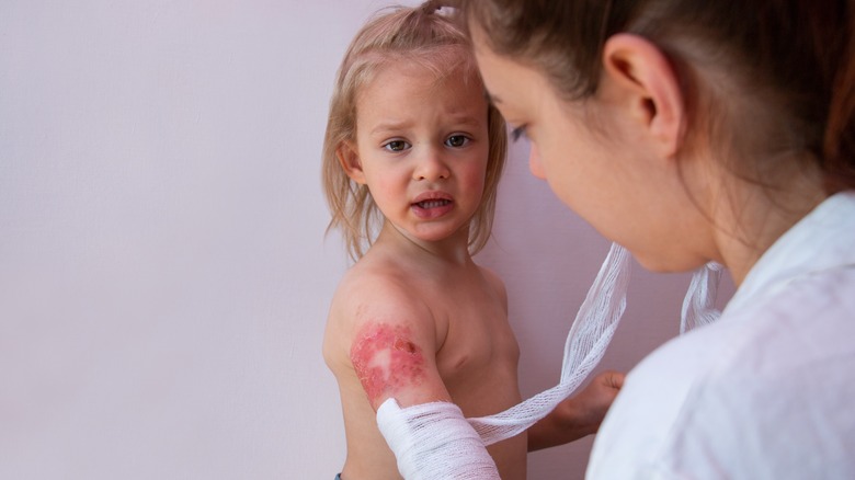 doctor dressing kid's arm burn