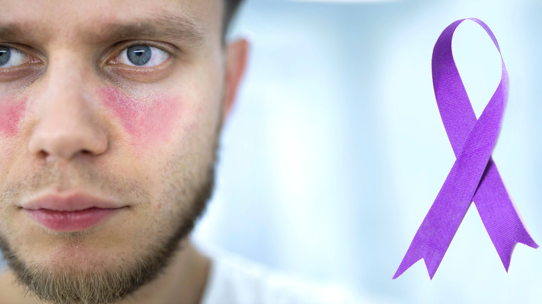 characteristic rash of lupus 