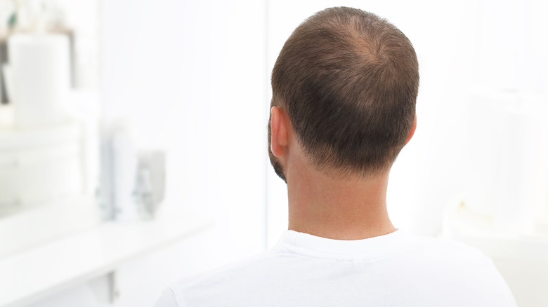 Man with androgenetic alopecia
