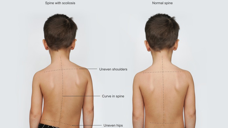 comparison of normal spine and scoliosis in child