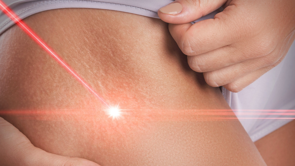 Laser treating stretch marks