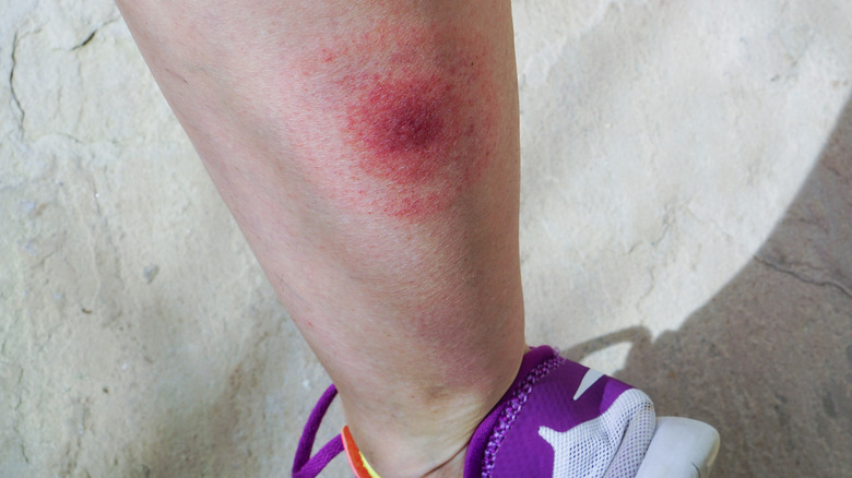 Woman with a bull's eye rash on her leg