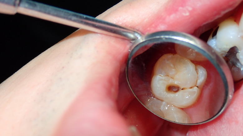 closeup of tooth decay