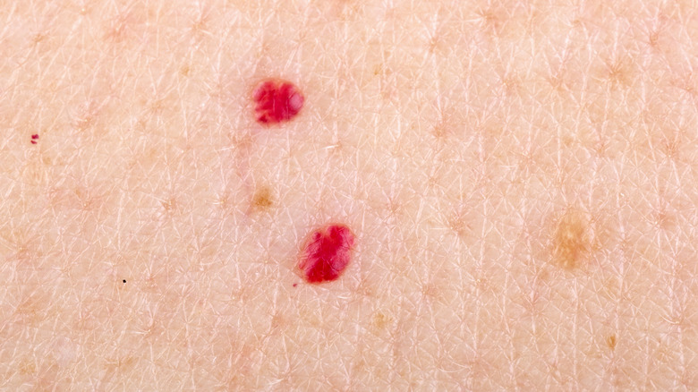 Cherry angioma on skin