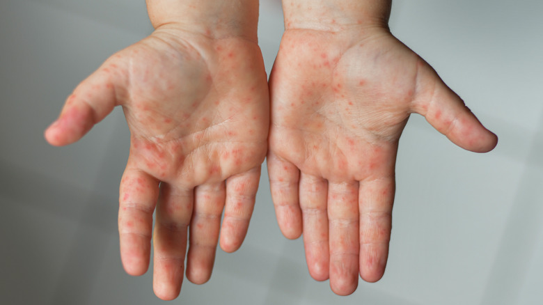 Child with rash on hands
