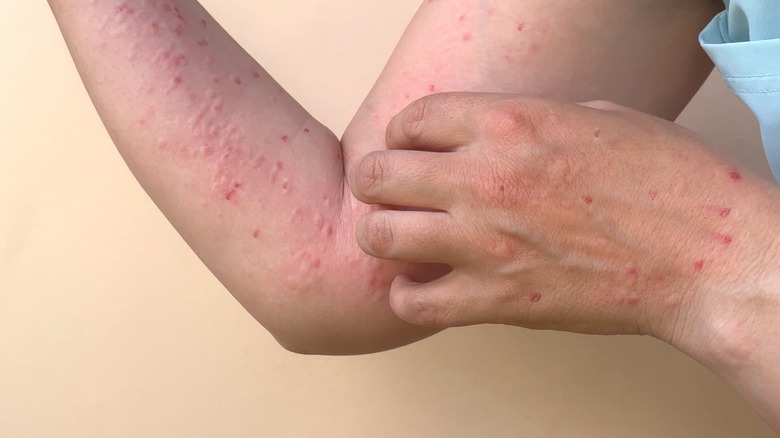 Person with skin rash