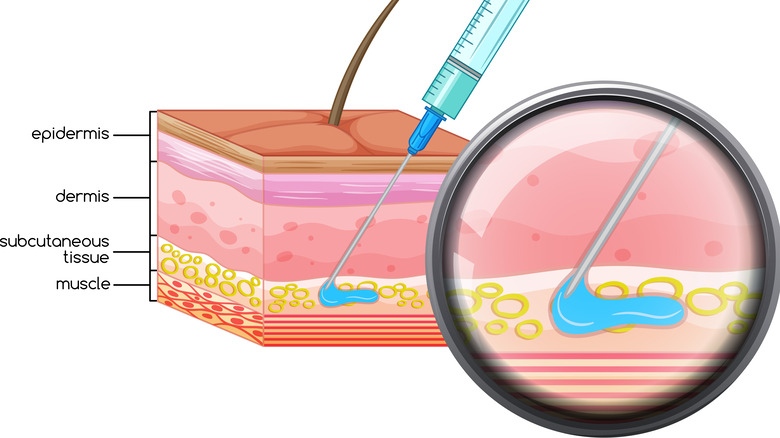 illustration of the layers of skin, showing the subcutaneous layer