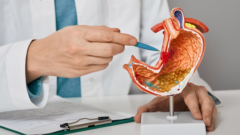 Doctor pointing an ulcer in stomach model