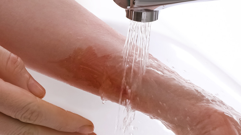 woman putting cool water on arm burn