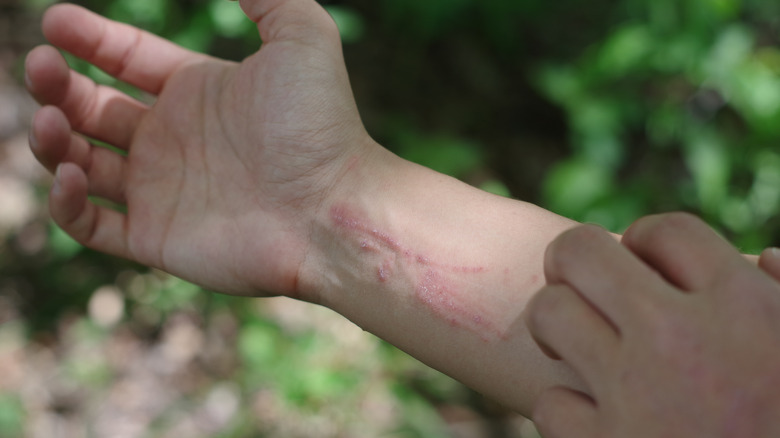 Person scratching poison ivy rash on arm