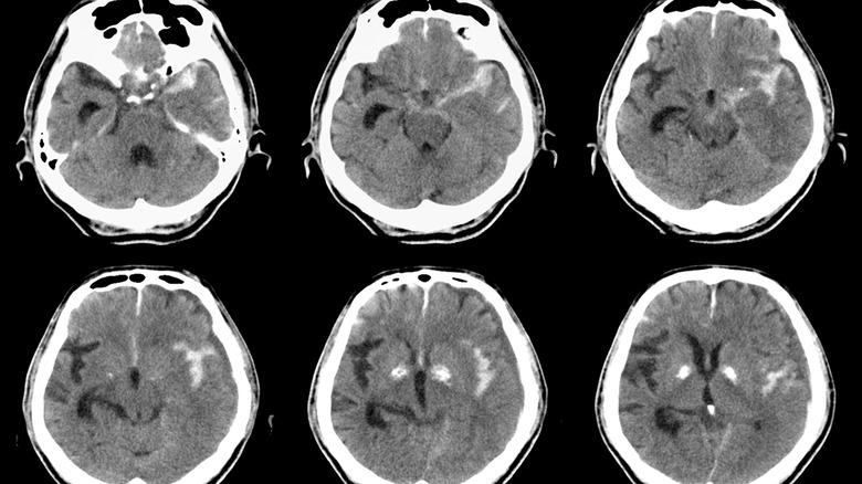 subarachnoid hemorrhage images