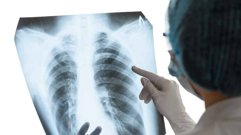 radiologist examining an X-ray of the lung