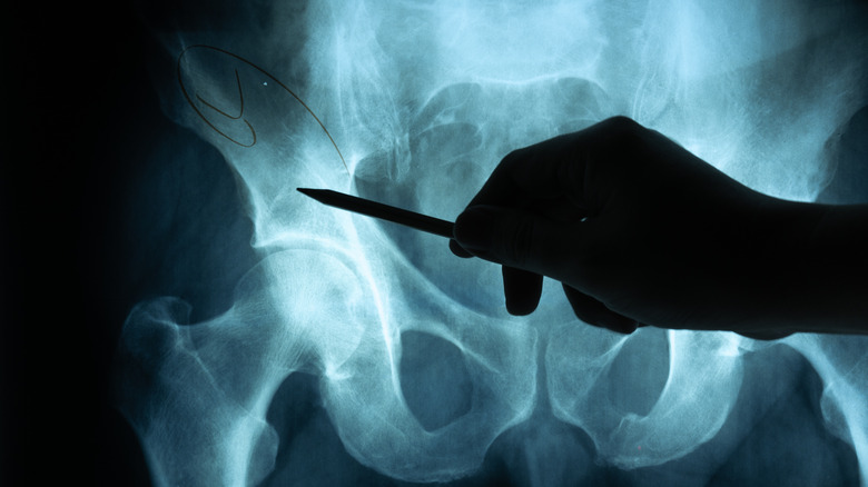 Silhouette of a hand holding a pen pointing to an xray of a hip bone