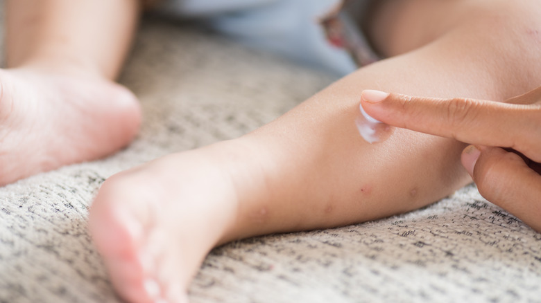 Applying calamine lotion