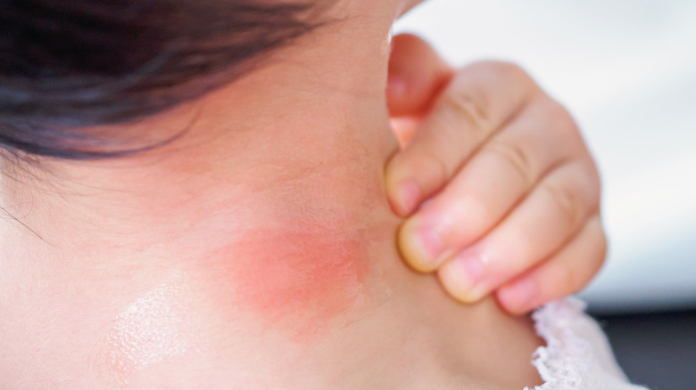 Person touches a red rash from a bug bite