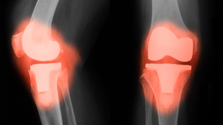 An x-ray of knee joints with red overlay on the knees