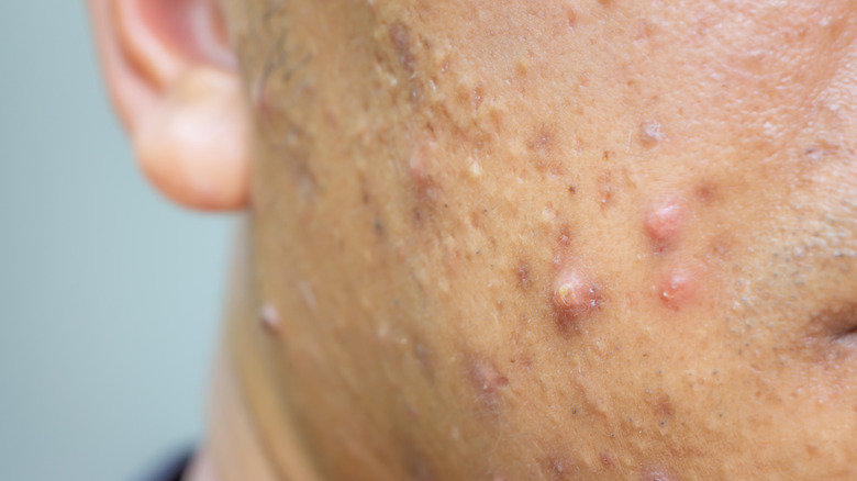 Man with cystic acne