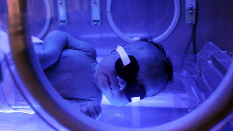 baby receiving phototherapy for jaundice