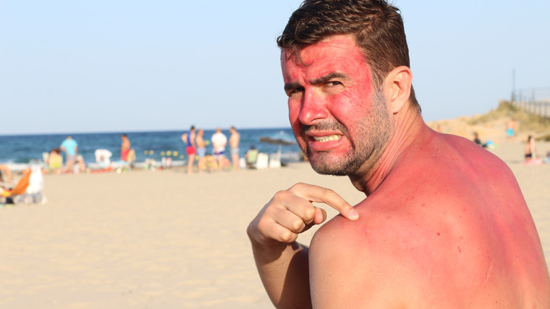 man with sunburnt skin