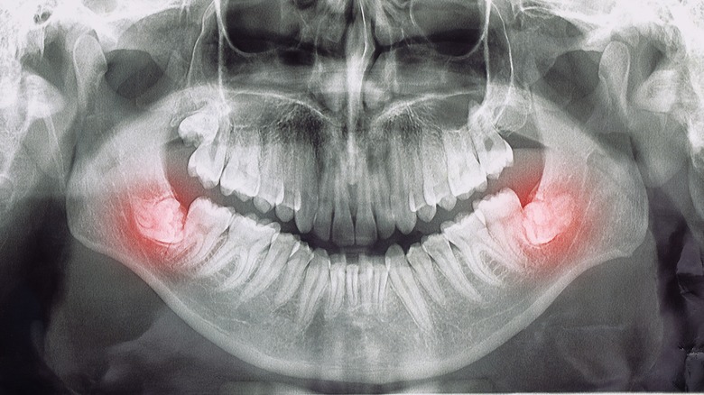X-ray of impacted wisdom teeth