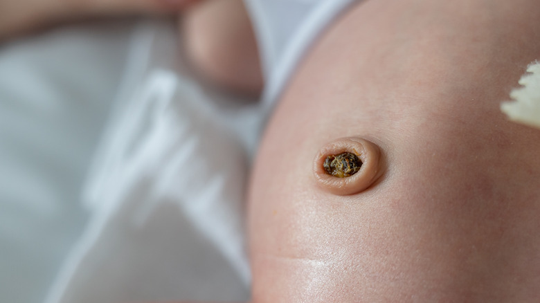 Baby abdomen with umbilical scab