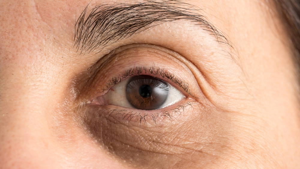 older man's eye with a dark circle under 