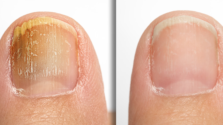 before and after fungal treatment of toenail