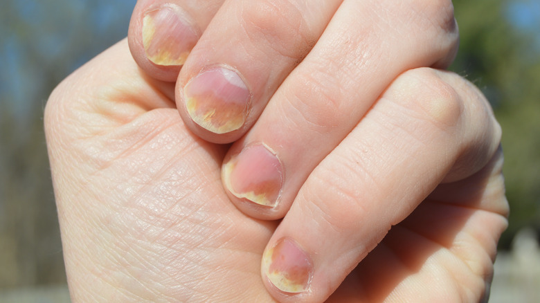 nail psoriasis on all fingernails of this hand